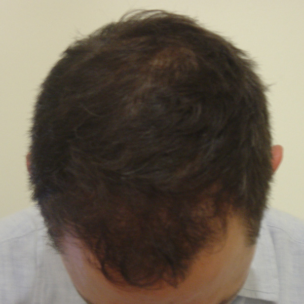 After Hair Transplant 05 - 2017
